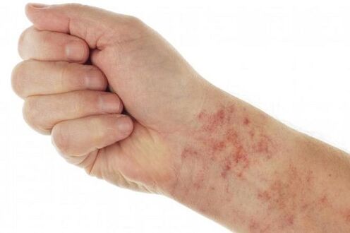 alergias devido a parasitas no corpo
